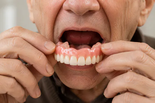 Complete dentures
