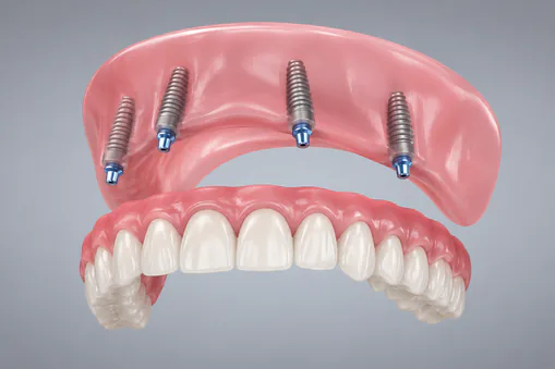 Implant supported dentures