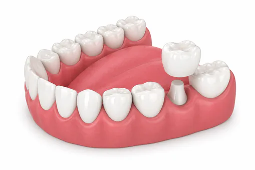 Dental crown materials illustration