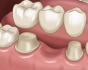 Dental Crowns And Bridges