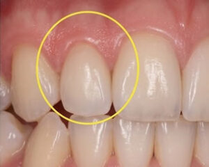 Gum Disease Treatment