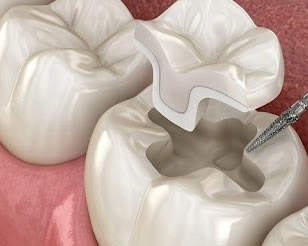 Porcelain And Composite Inlays