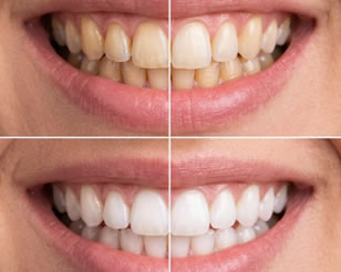 Teeth Whitening